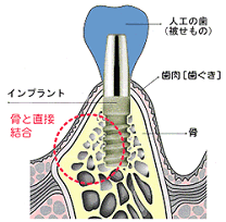 インプラント