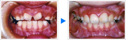 矯正症例