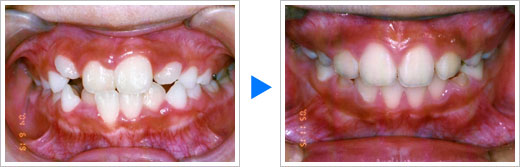 矯正症例